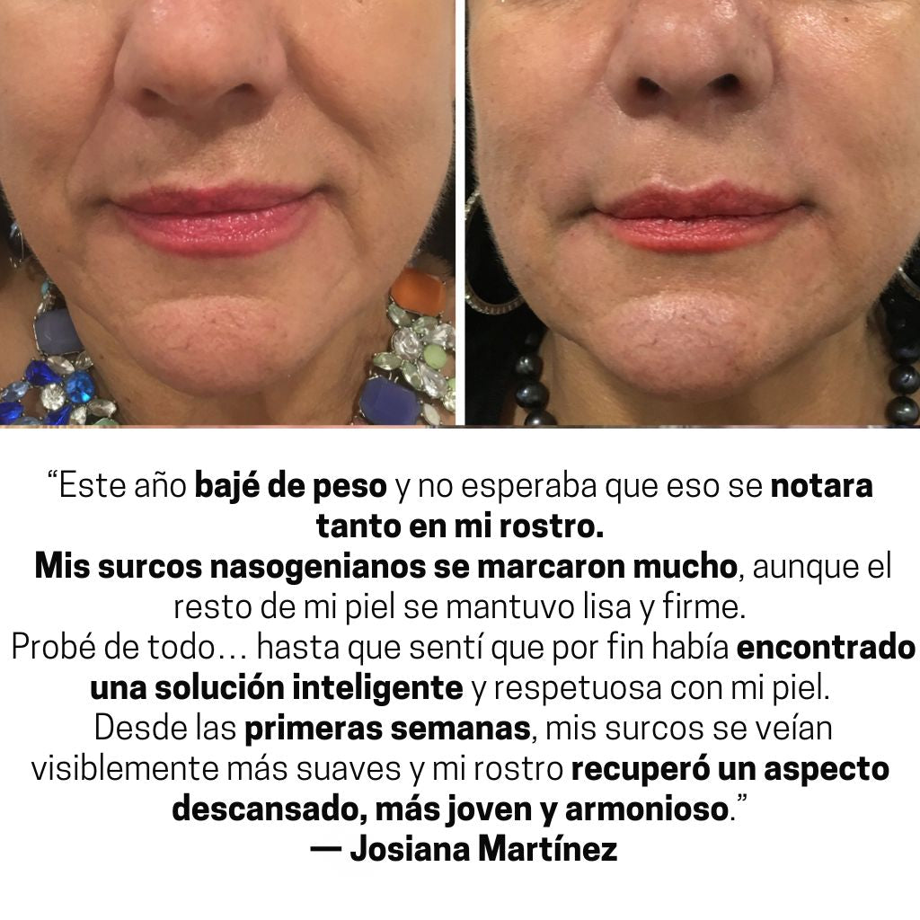 ProLift 2.0 Parche de Micro-Conos Nasogenianos