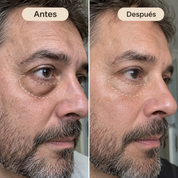 ProLift 2.0 Micro-Conos para Ojos Maduros